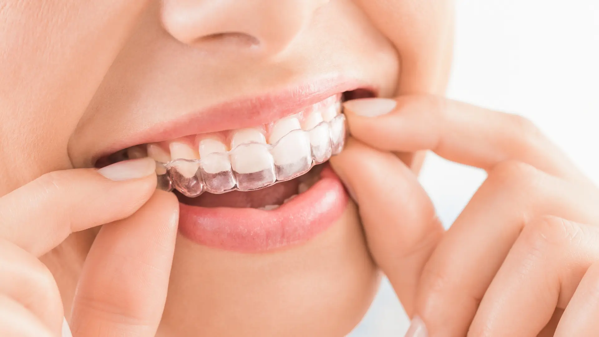 Close-up of a woman smiling with clear aligner