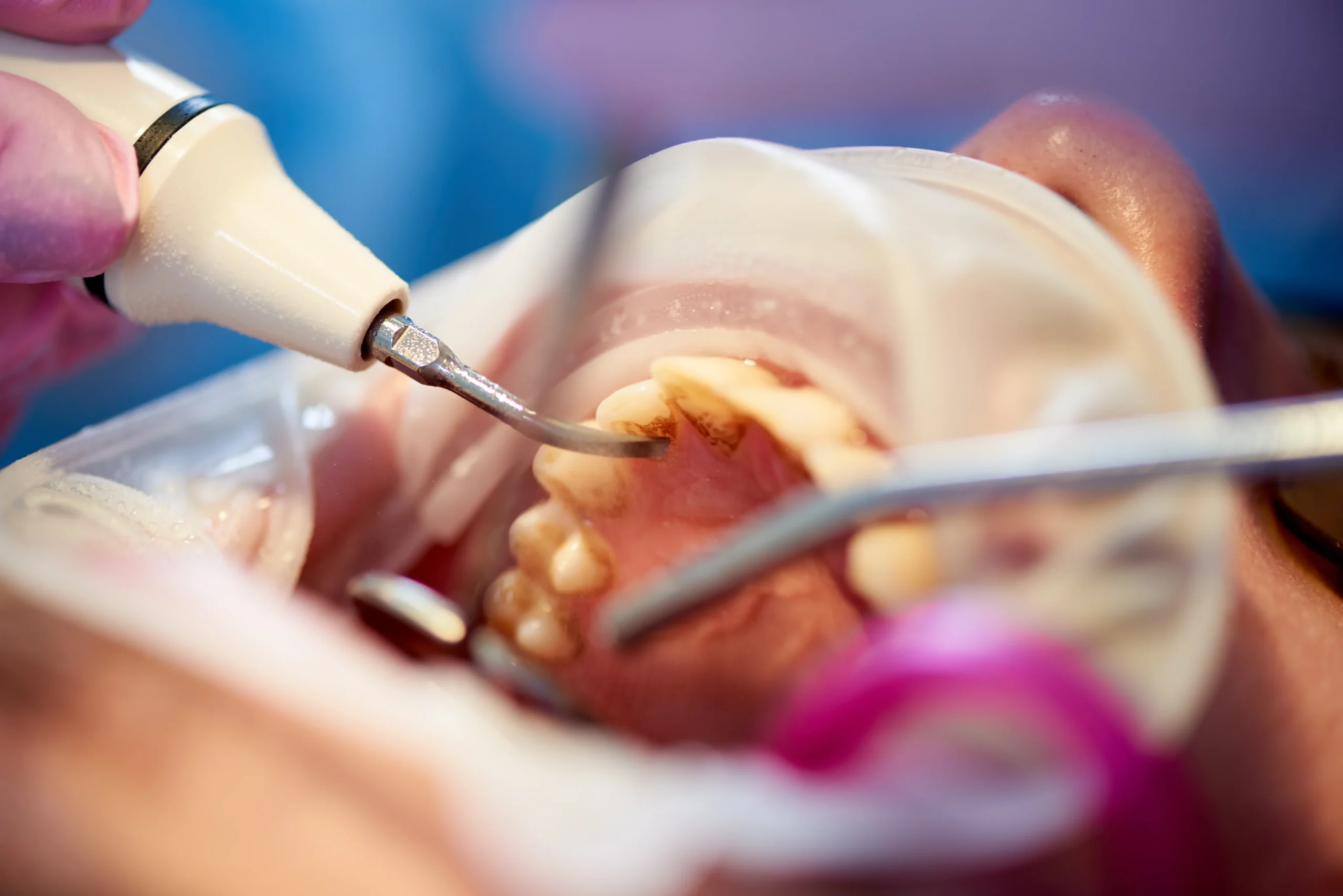 Dental hygienist performing a teeth cleaning procedure
