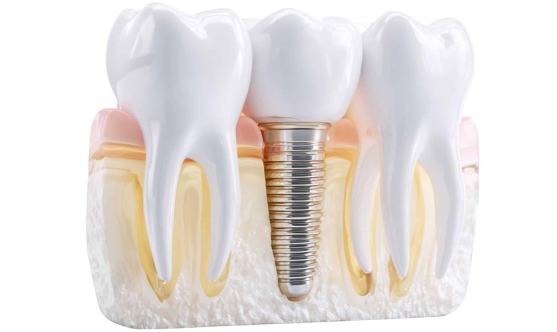 dental implant