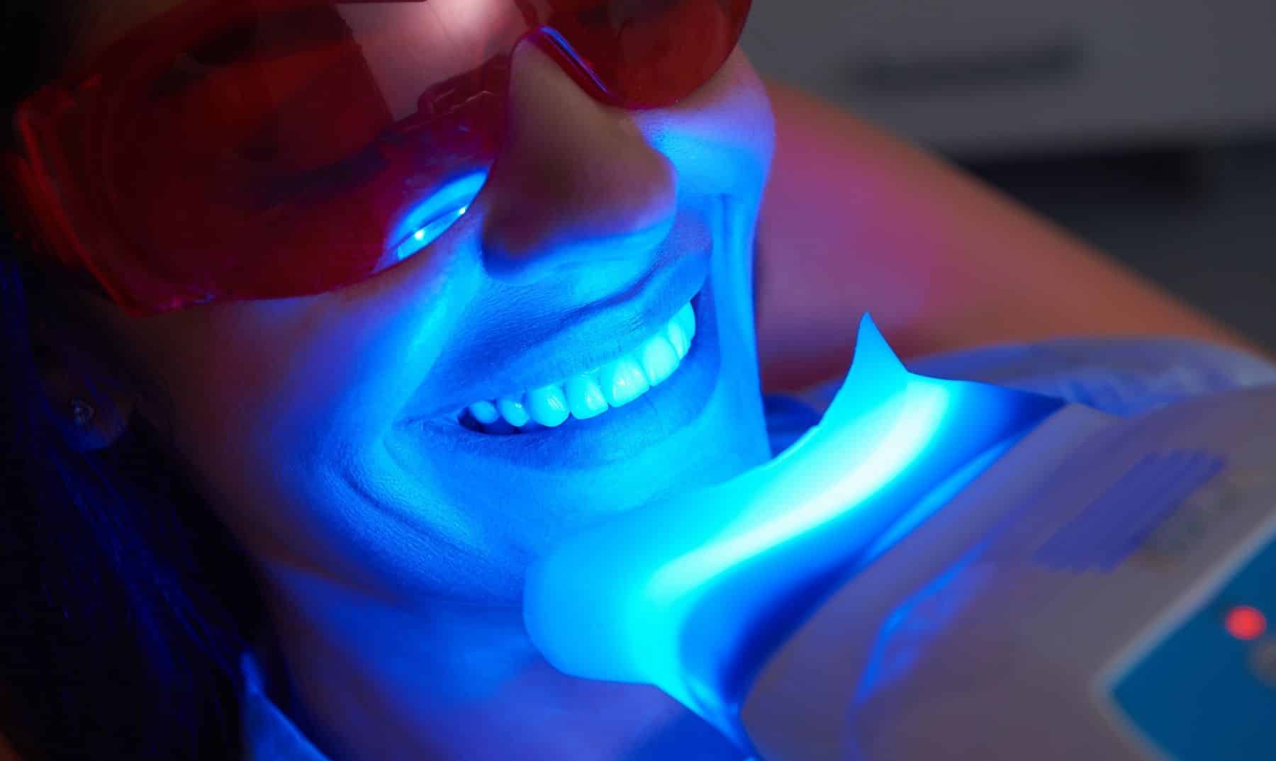 teeth whitening in Chester