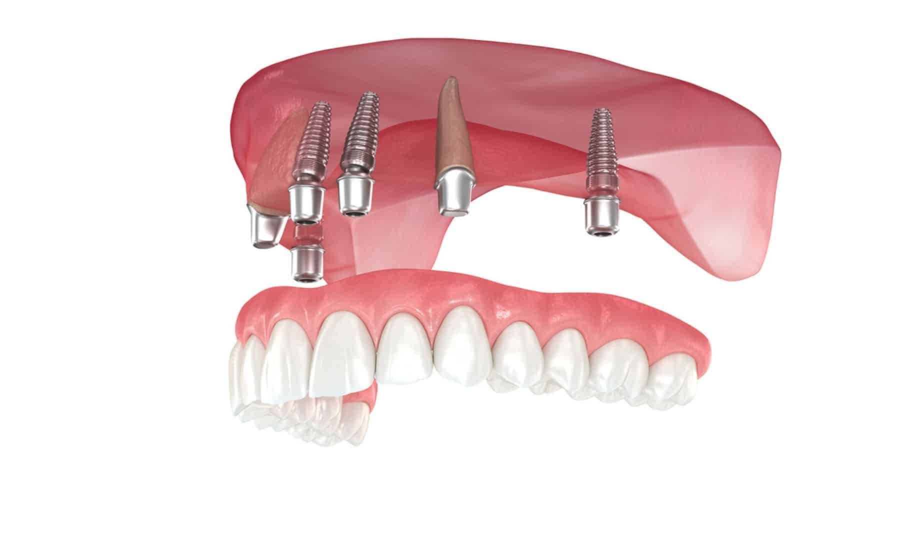 all on 4 implants