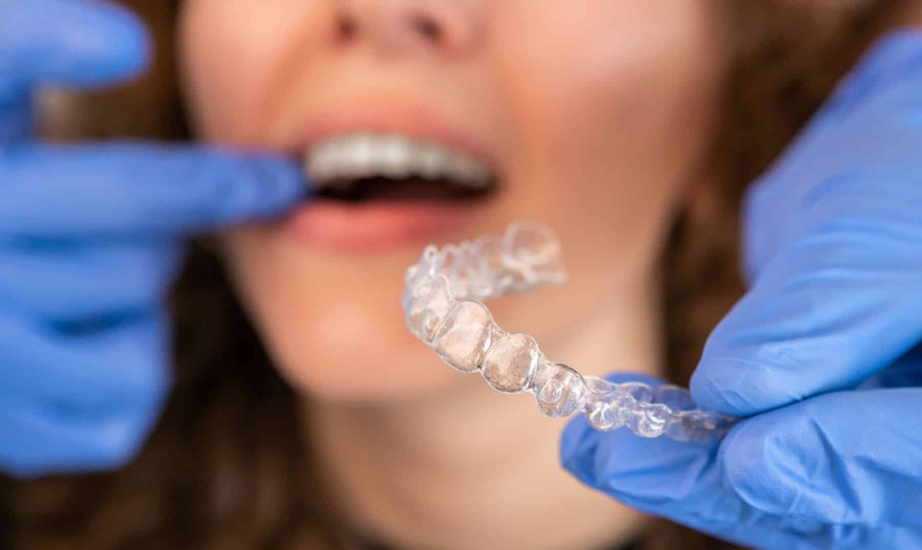 invisalign clear aligners