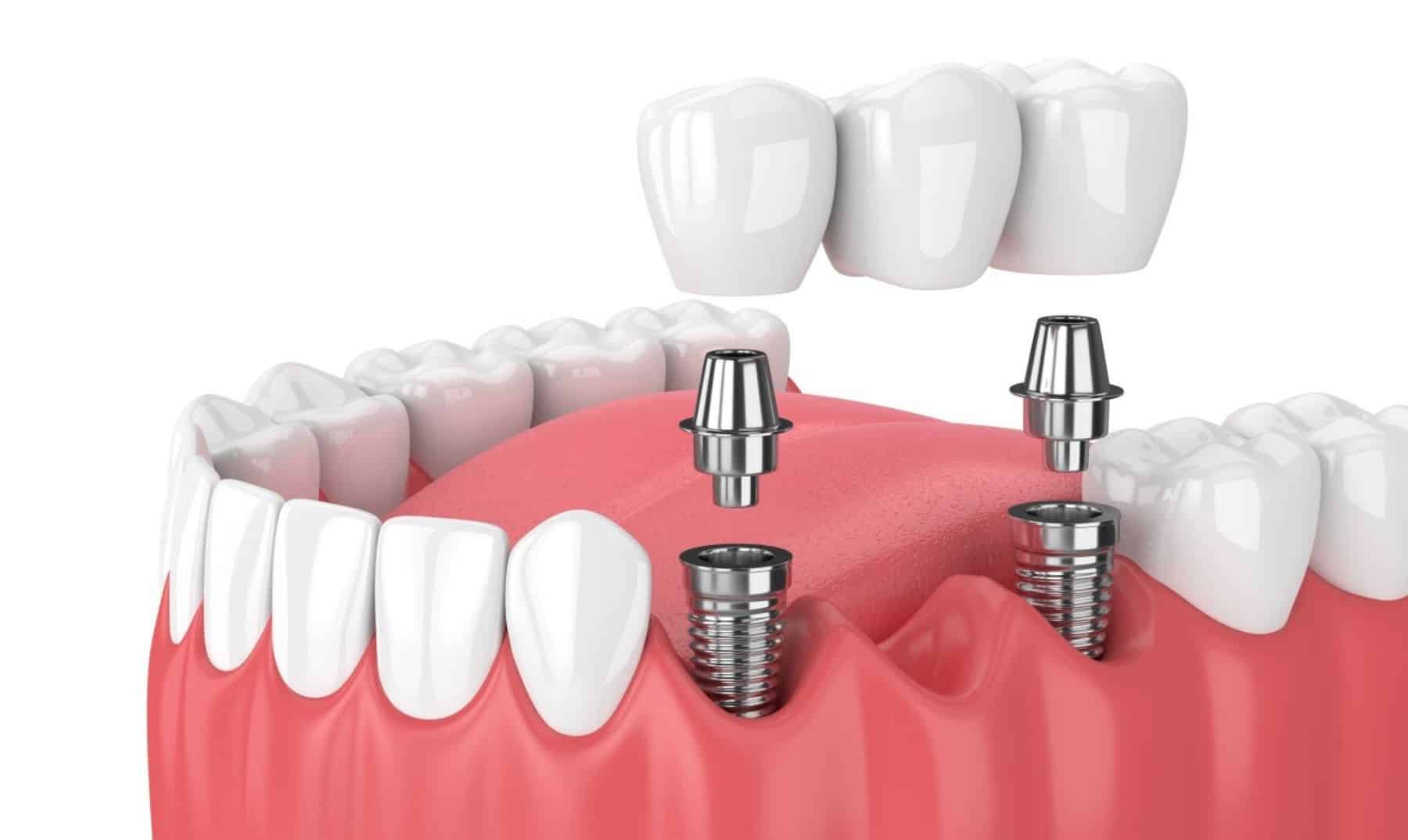 implant bridge