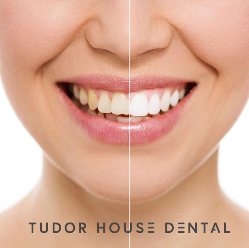 Chester Teeth Whitening