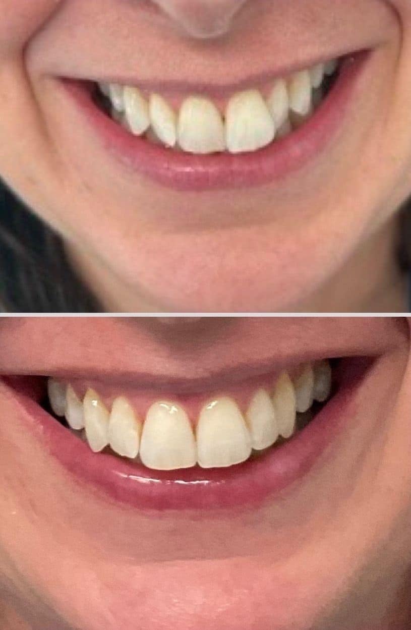 before and after aligners