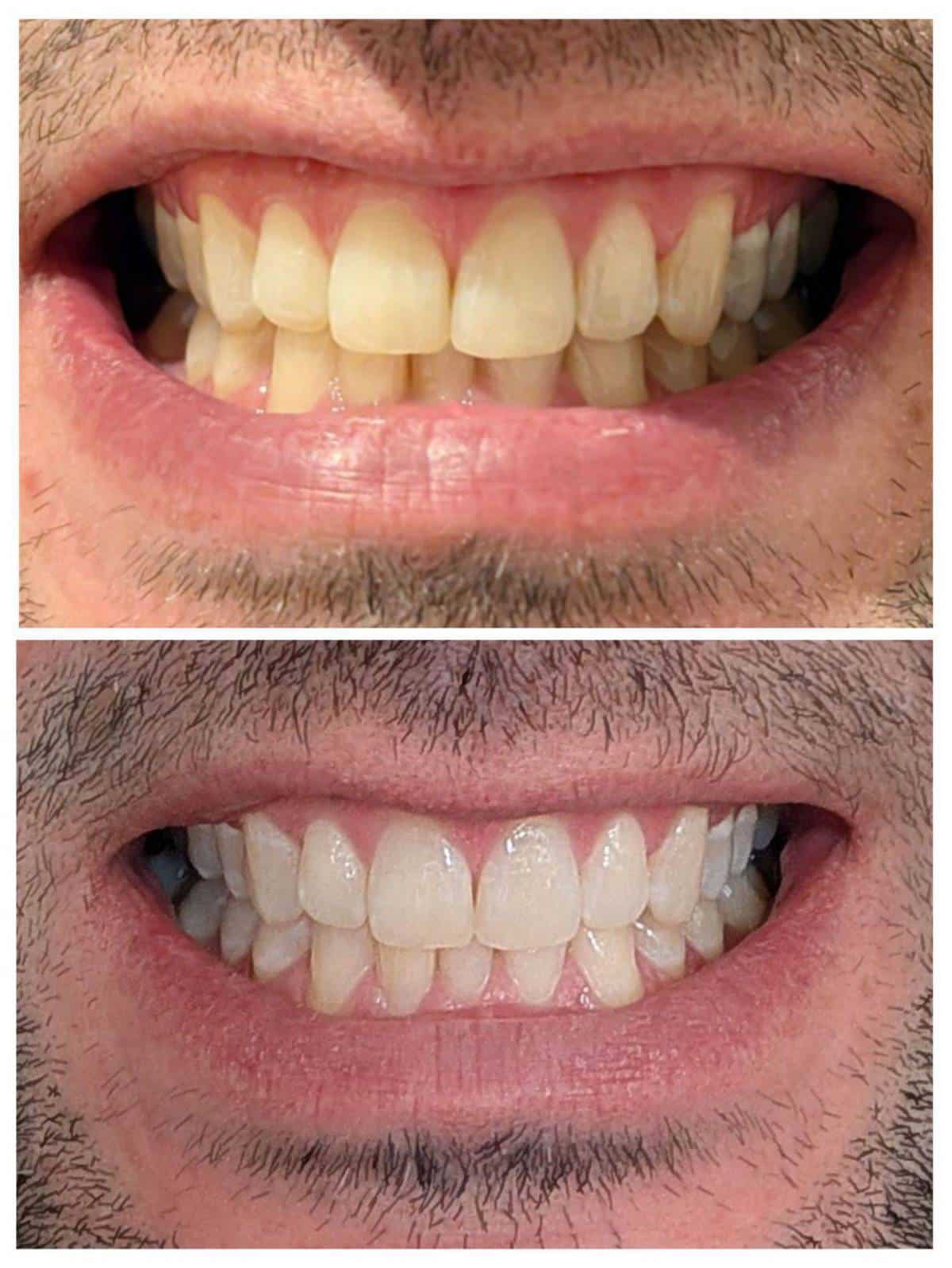 before and after teeth whitening