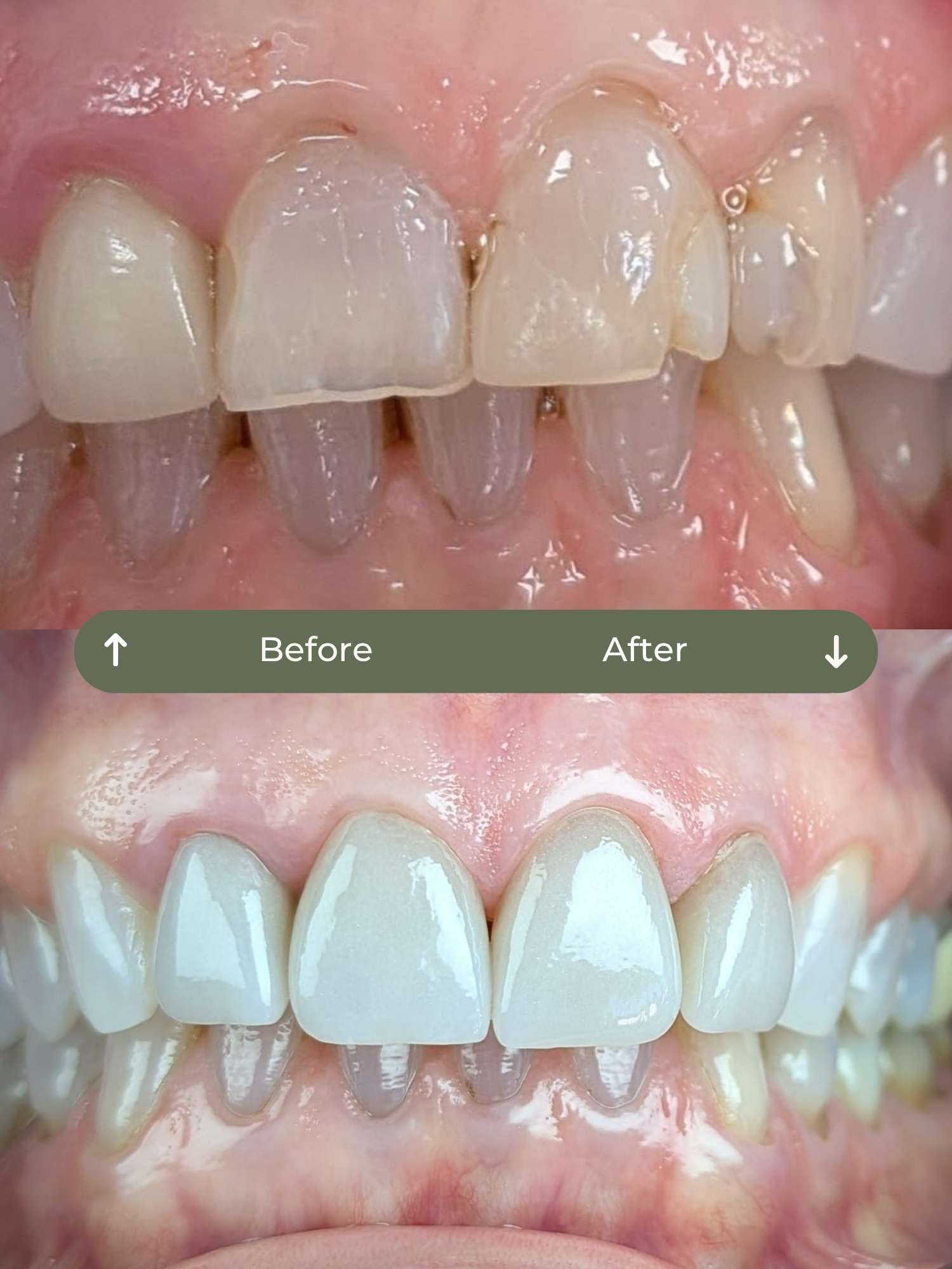 before and after veneers