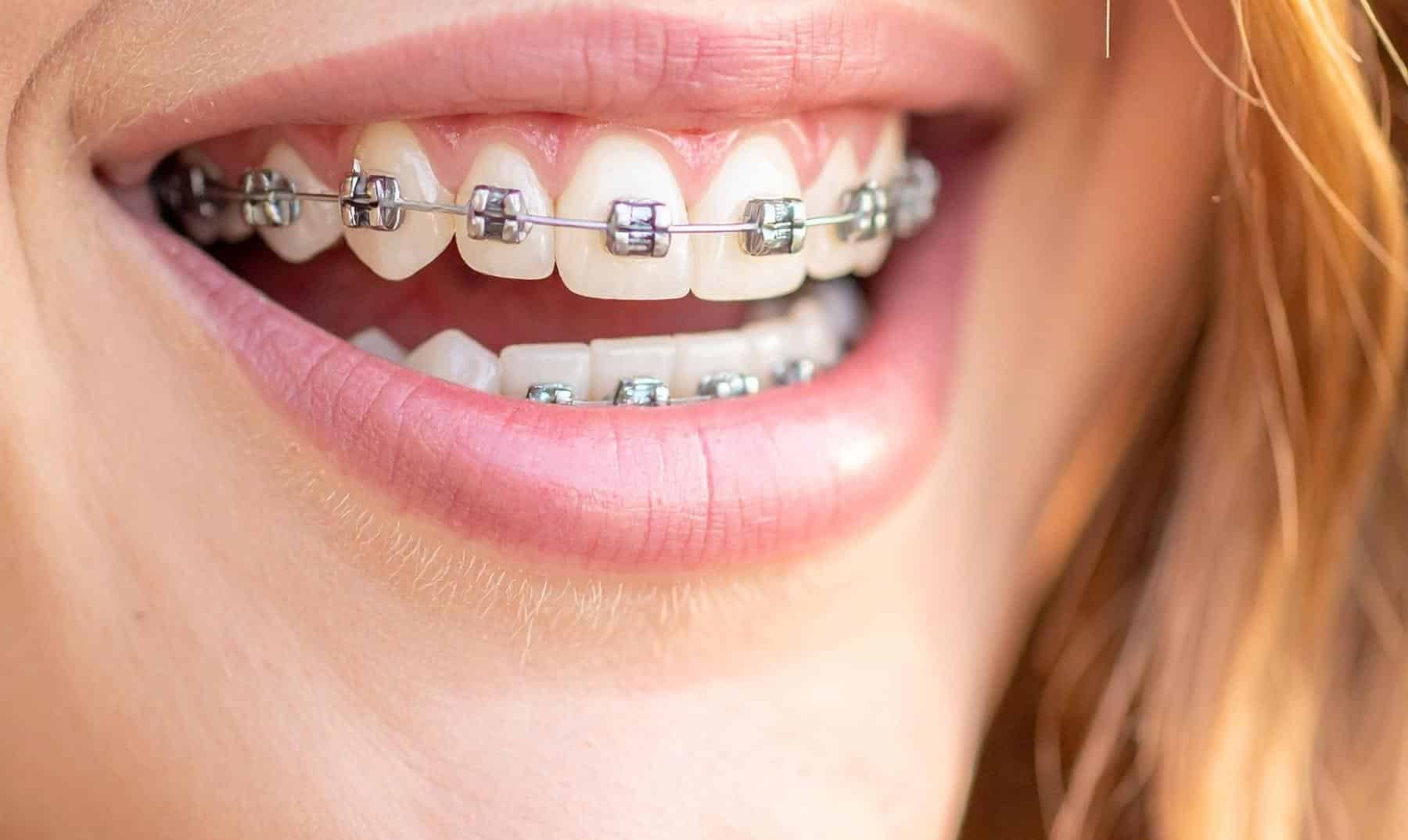 braces