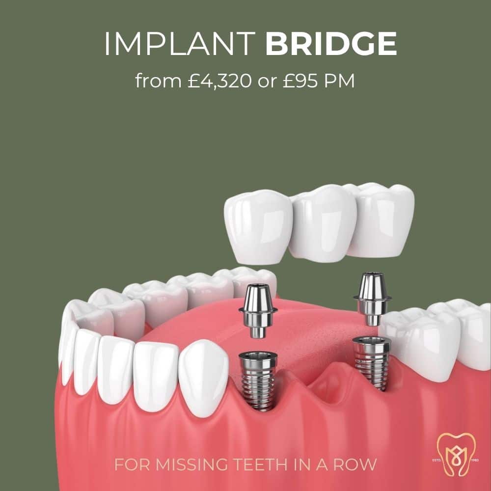 implant bridge