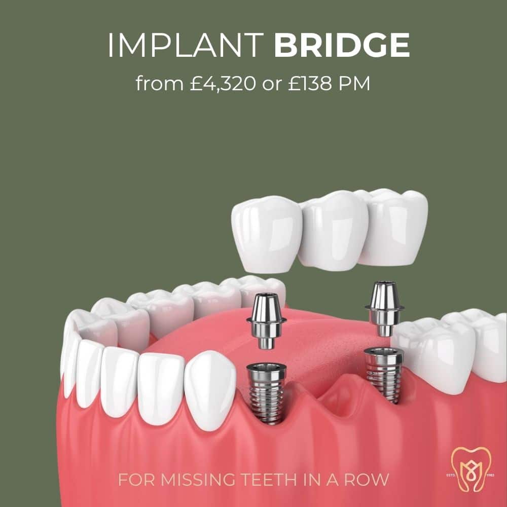implant bridge