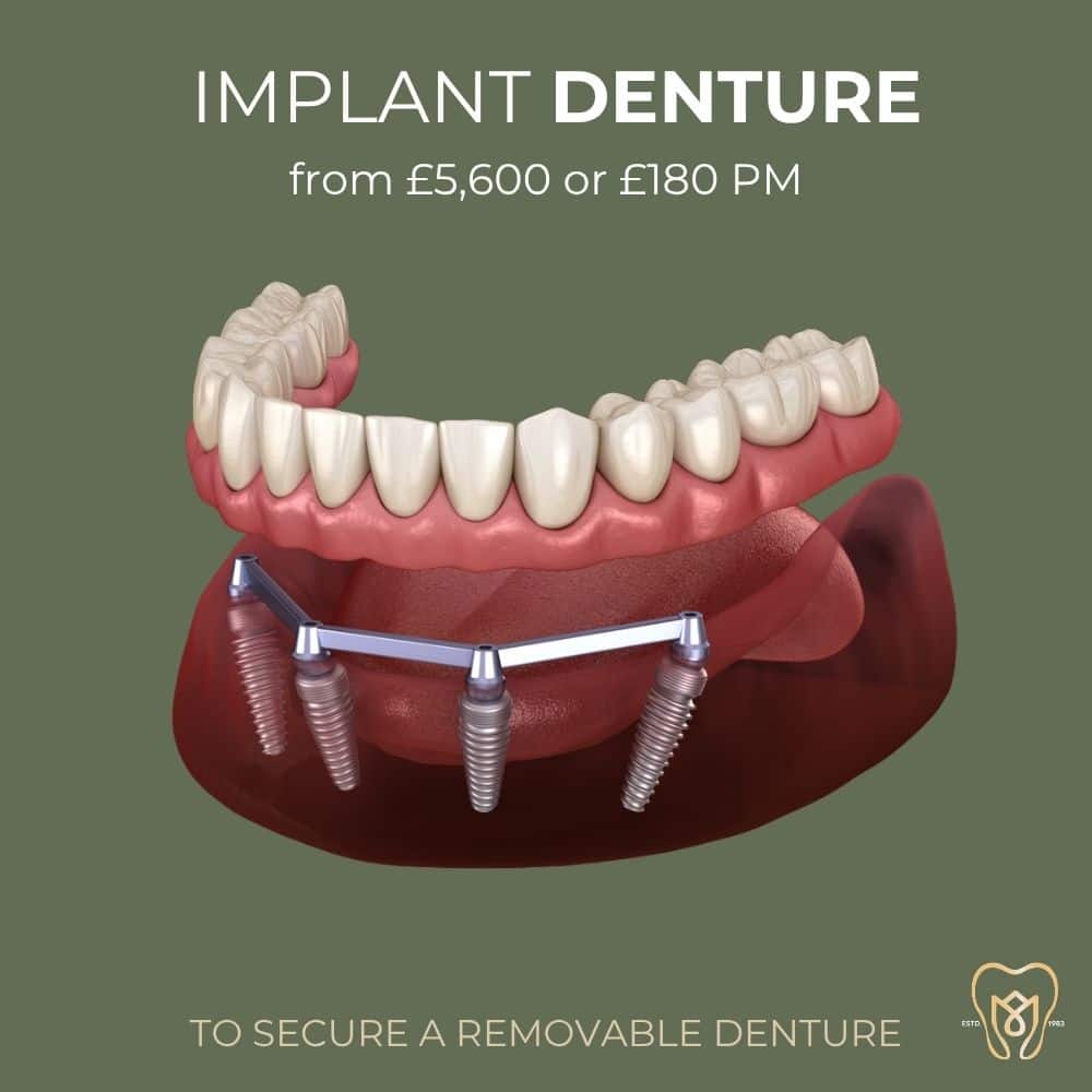 implant denture