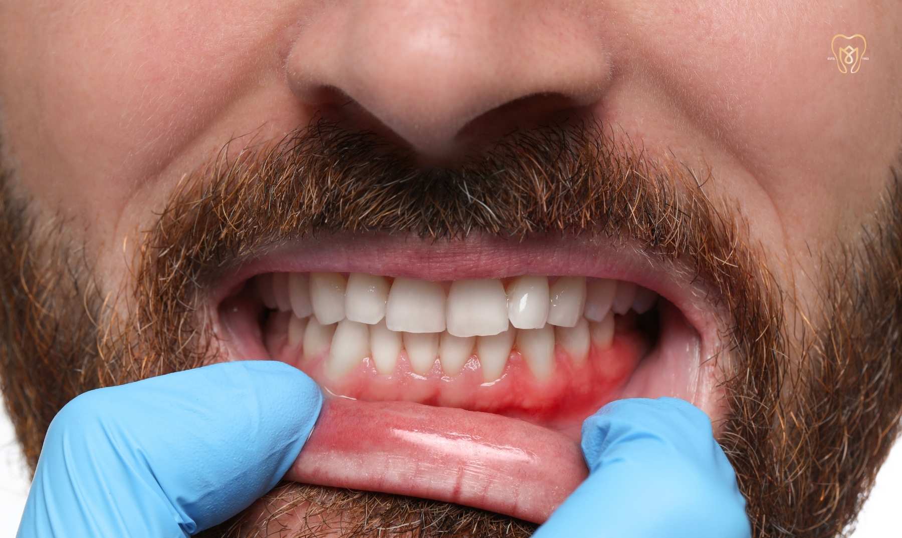 abscess