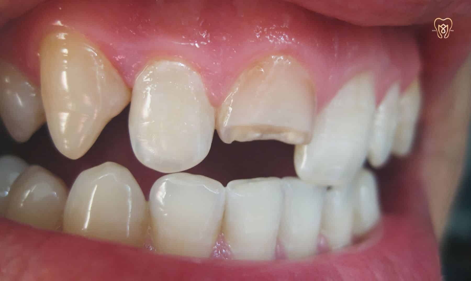broken tooth