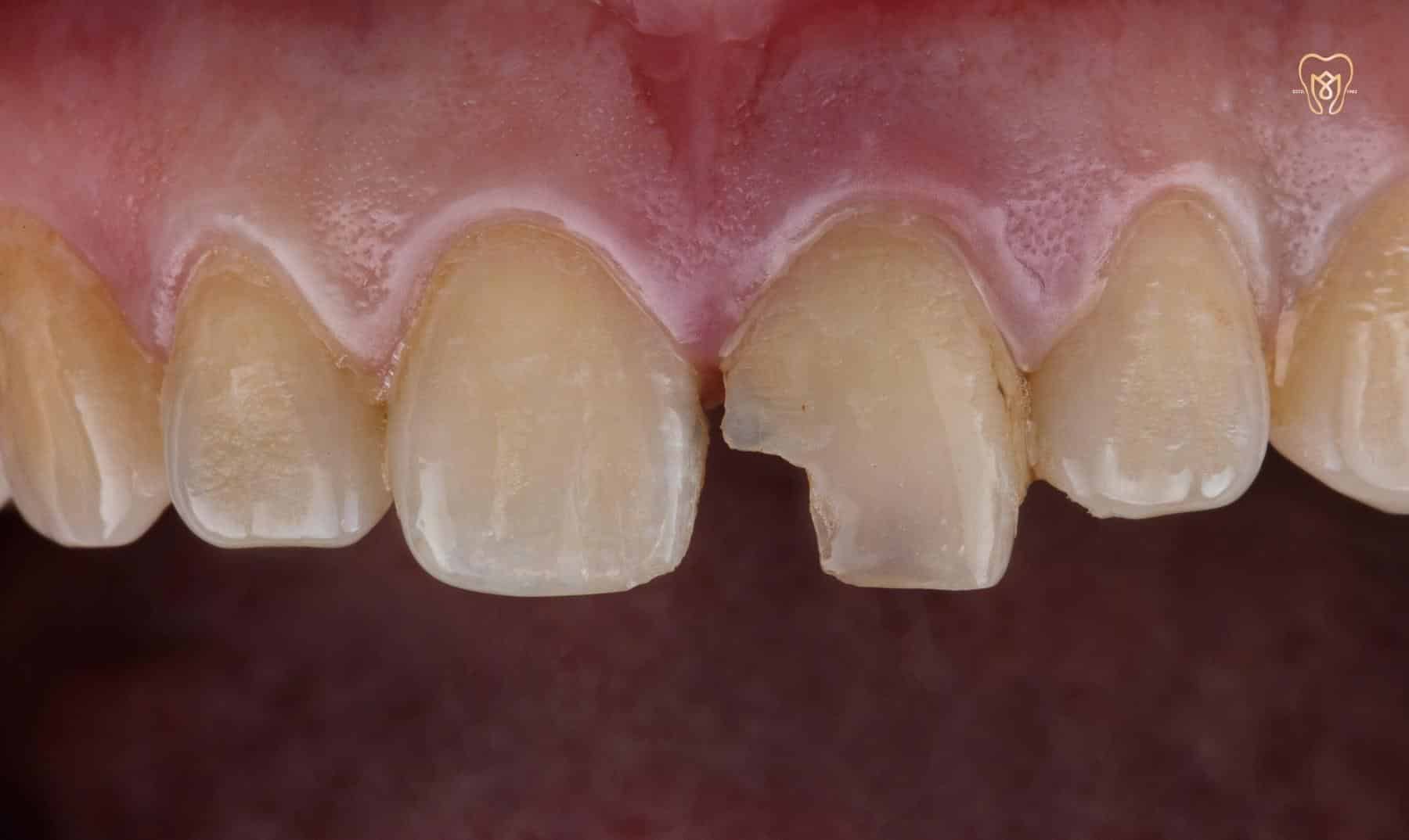chipped tooth