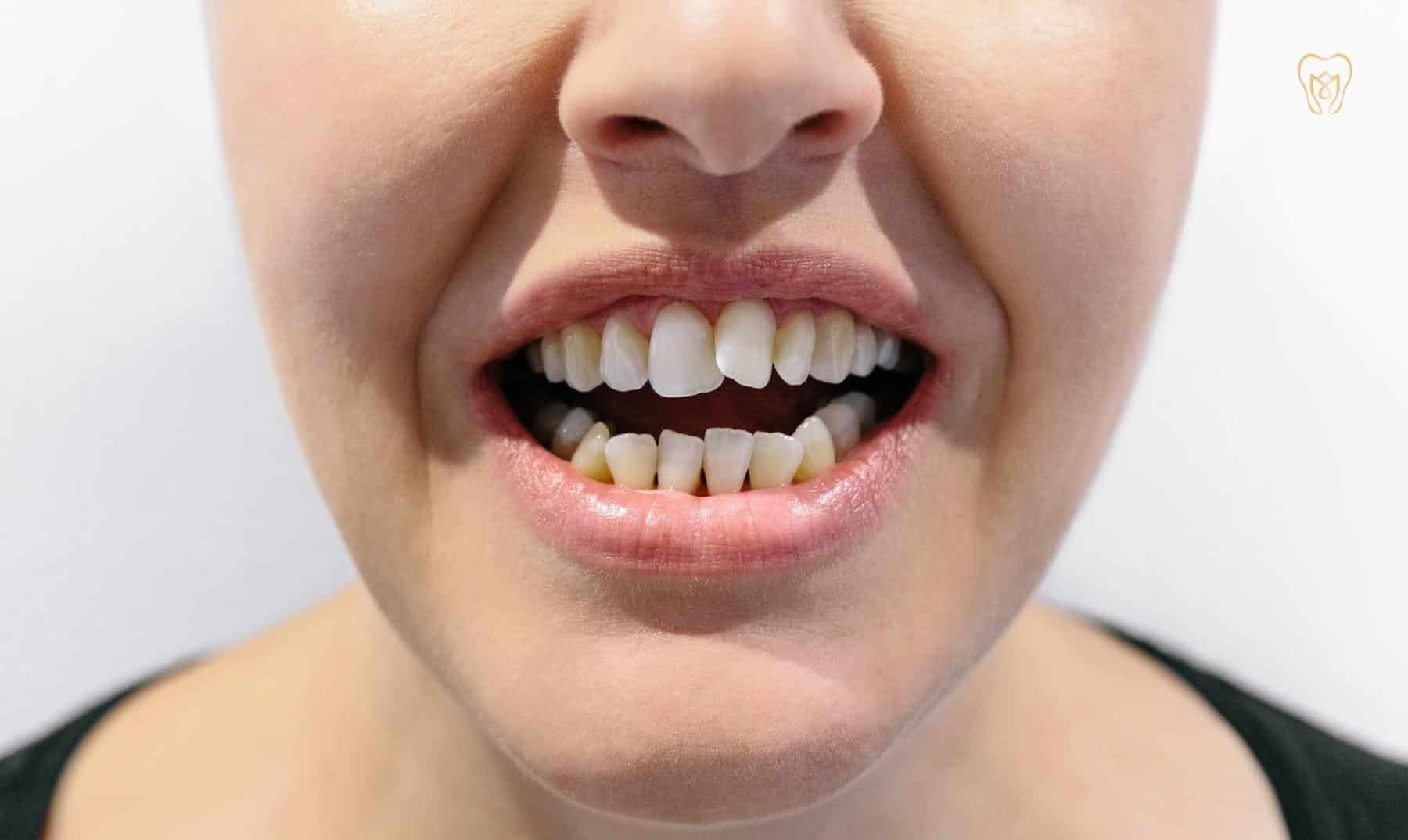 crooked teeth