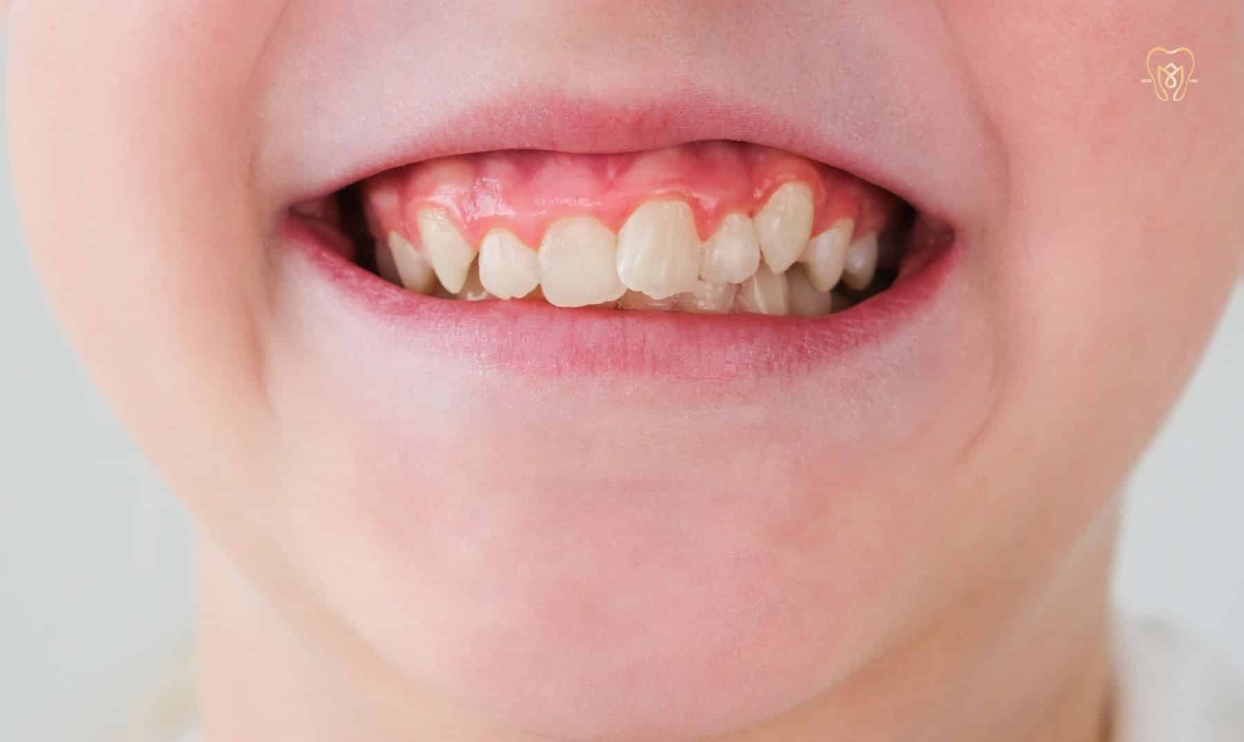 crowded teeth