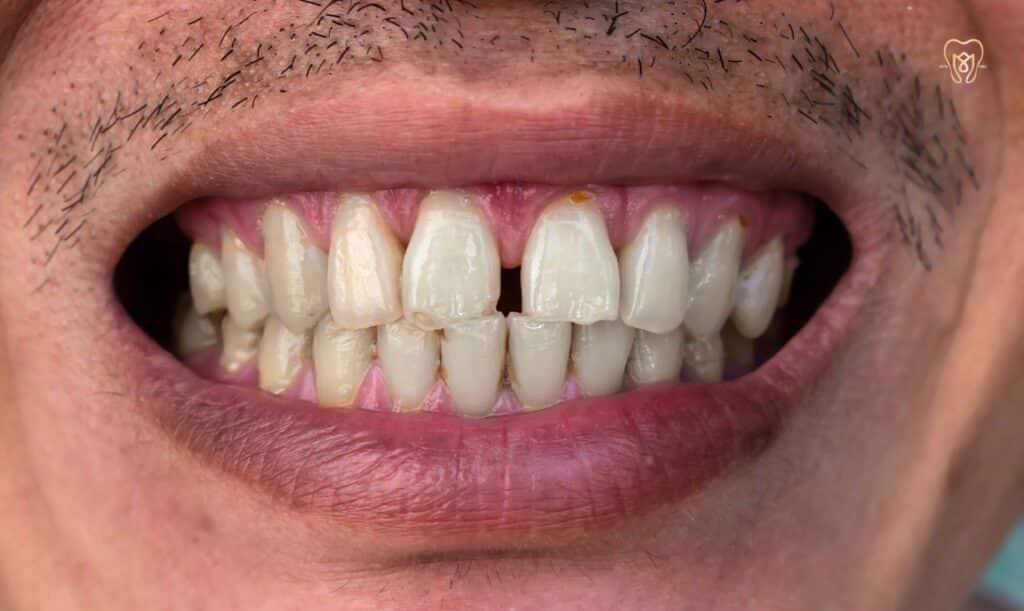 gapped teeth