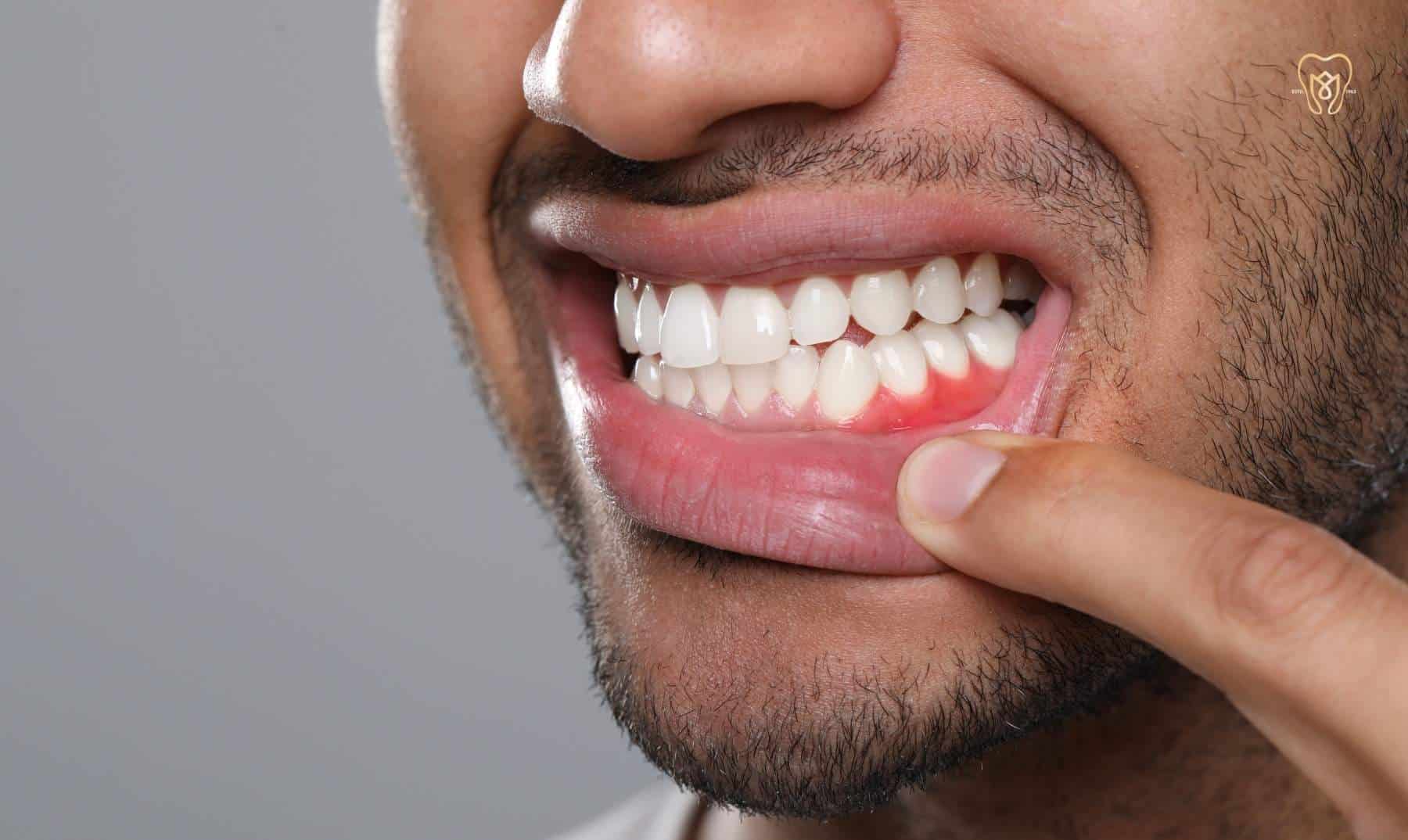 gum disease