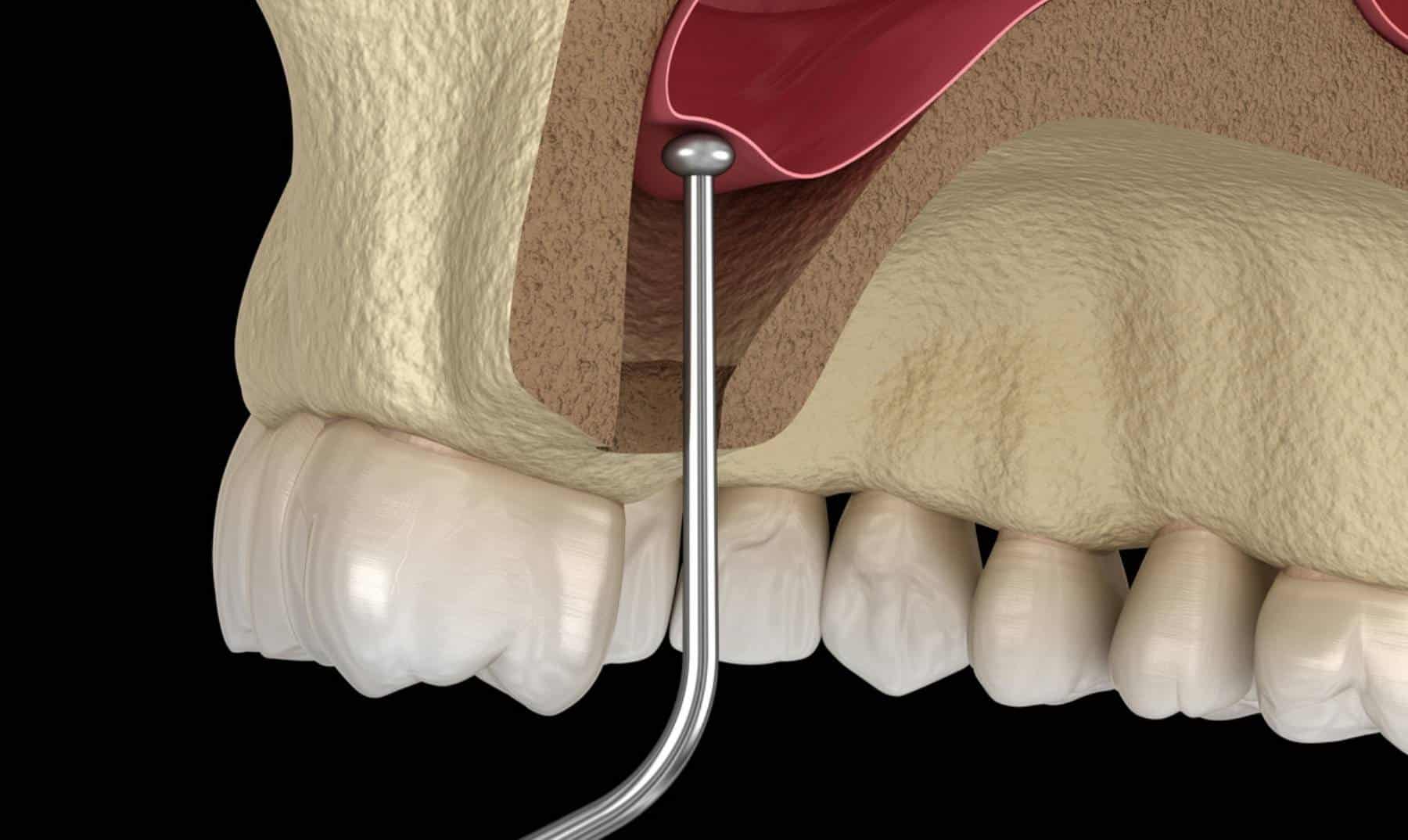 sinus lift