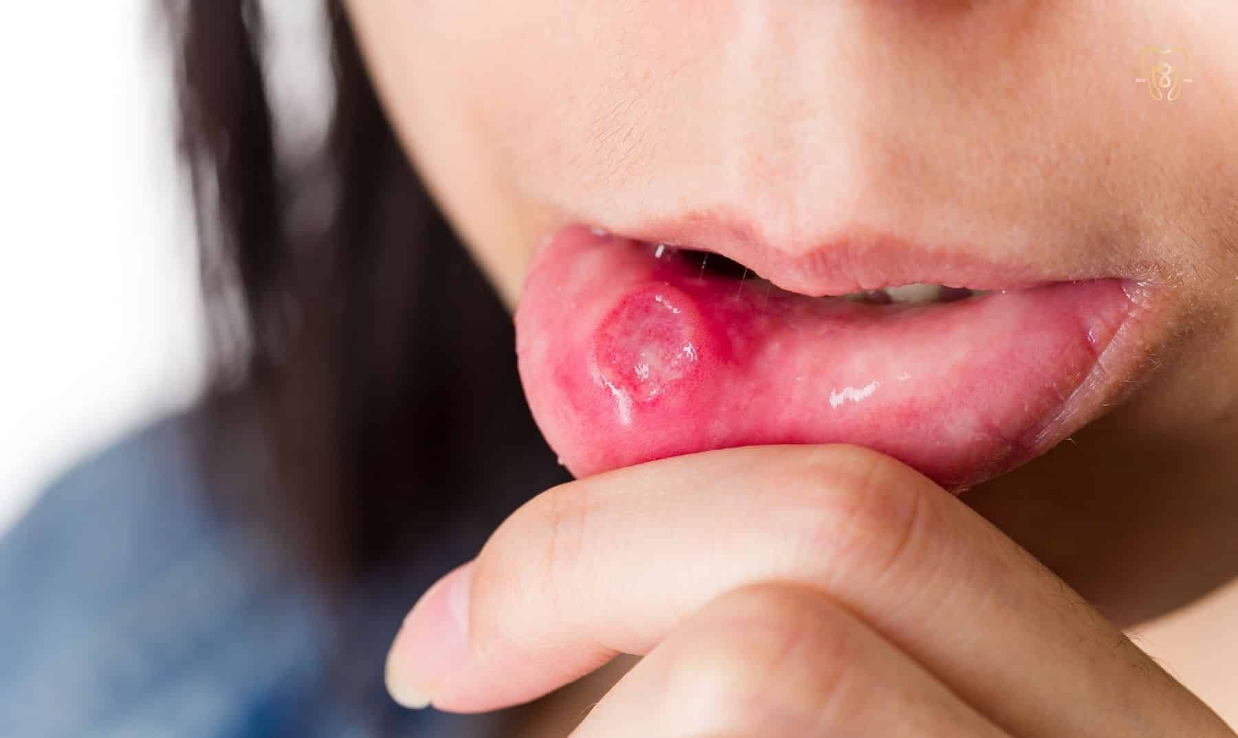 ulcers