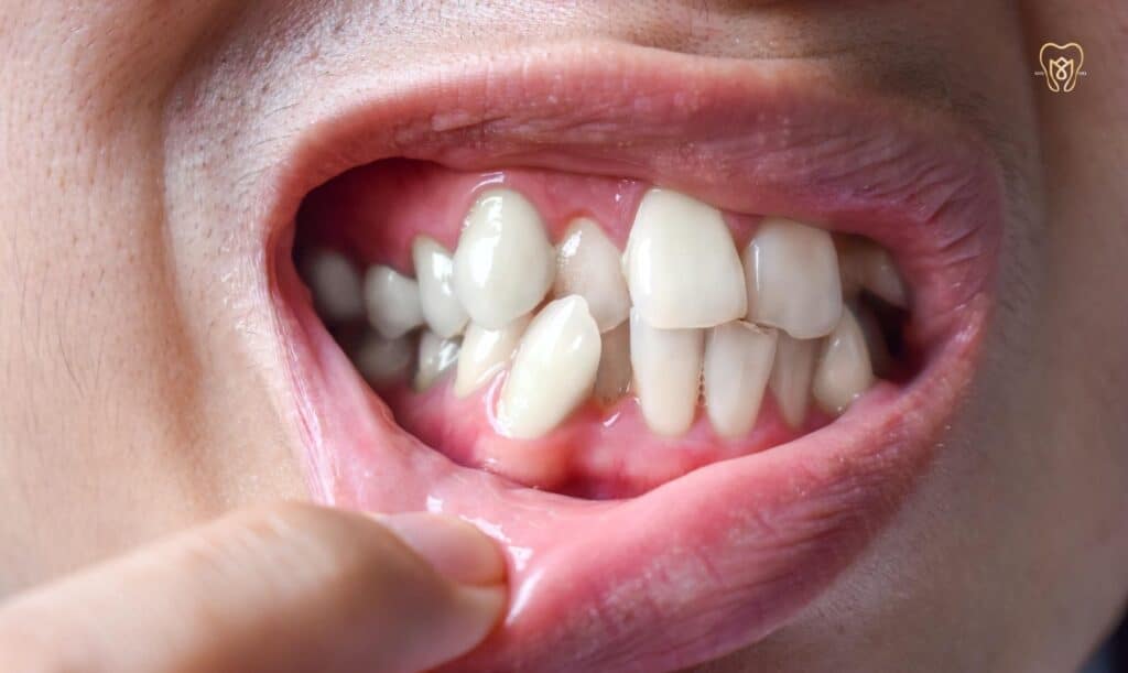 wonky teeth