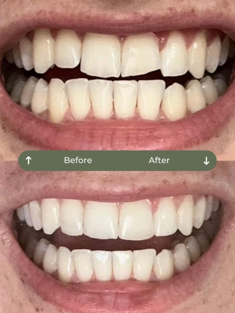 before and after clear aligners, whitening & bonding