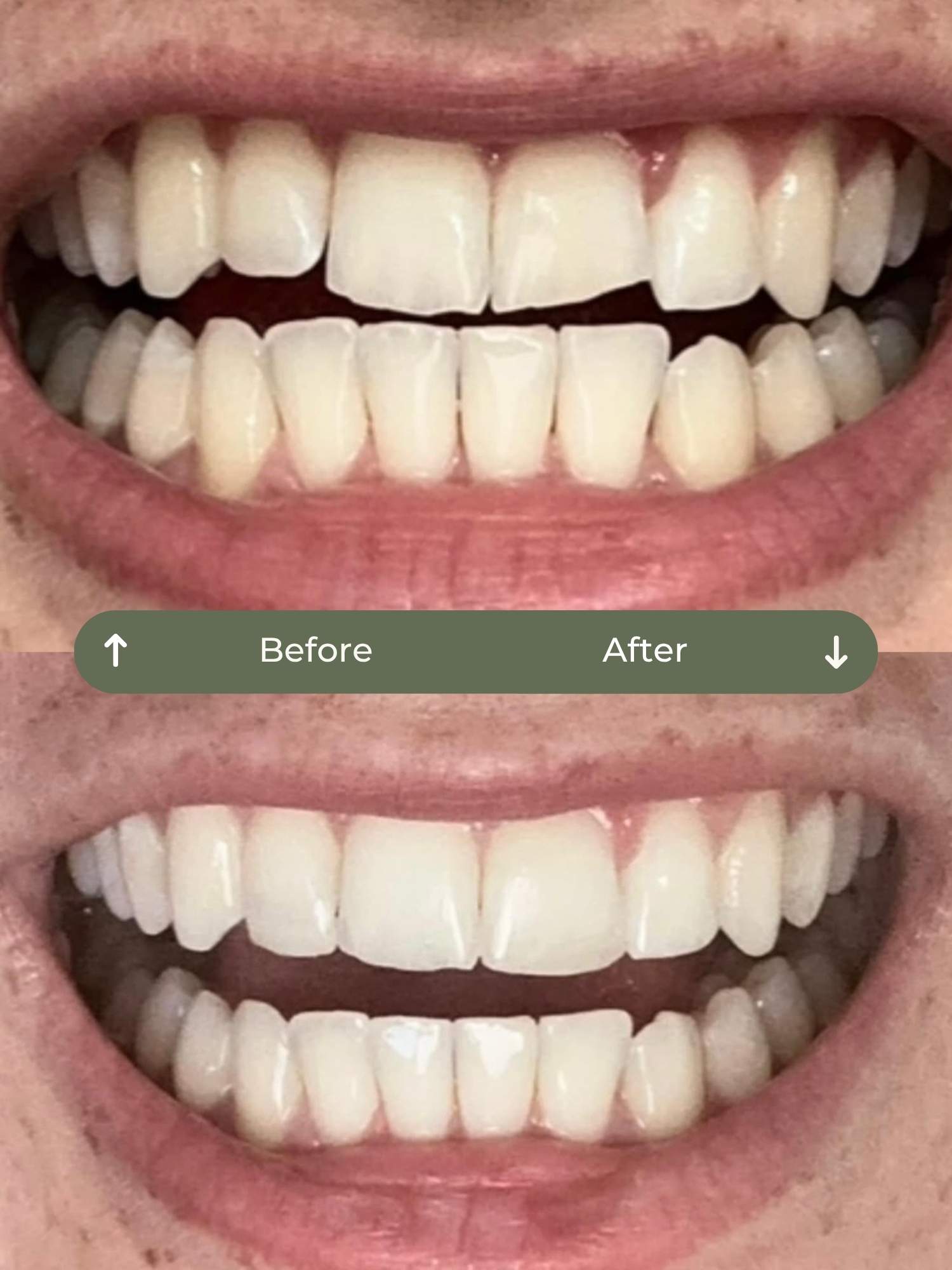 before and after clear aligners, whitening & bonding