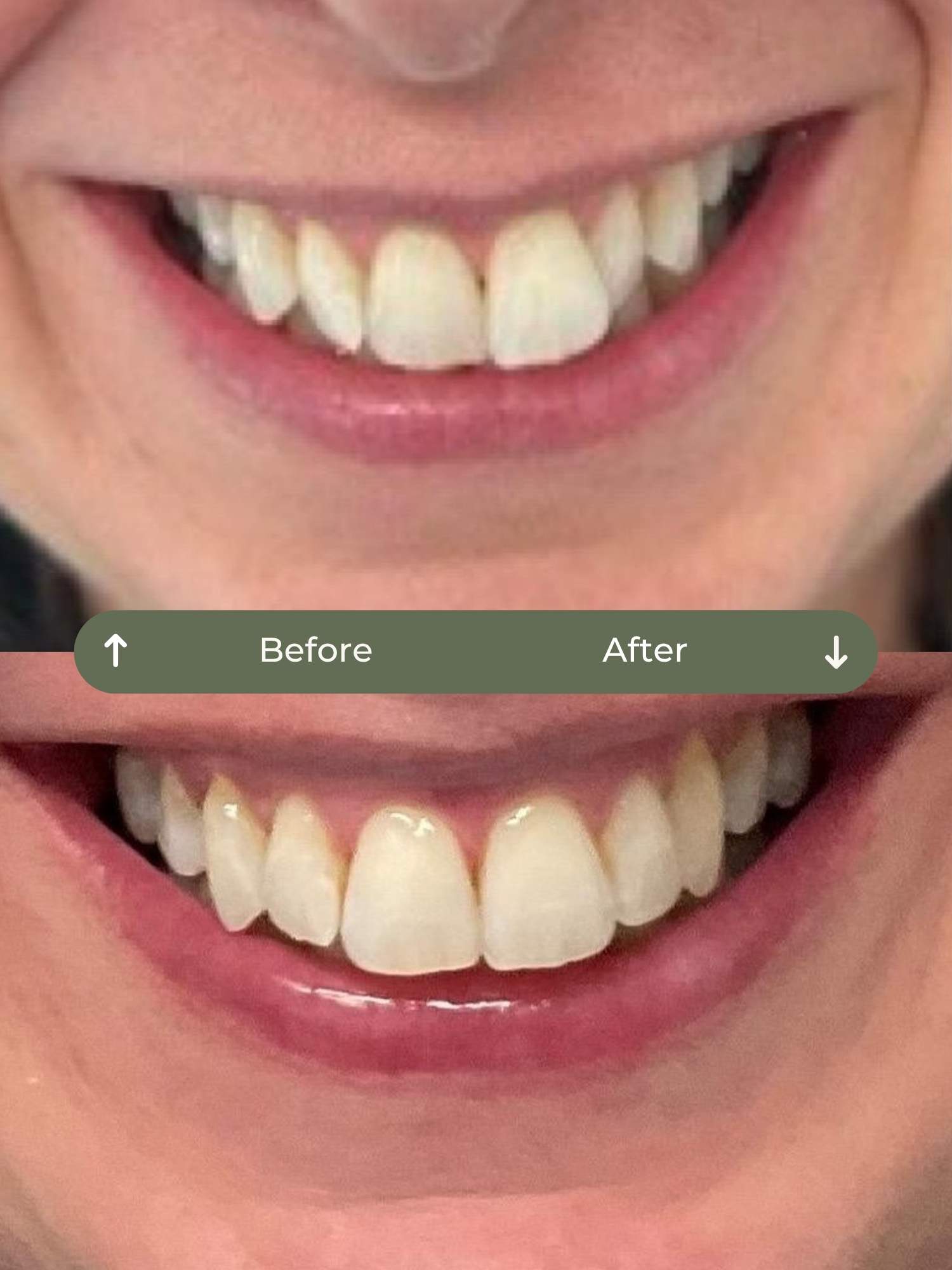 before and after clear aligners