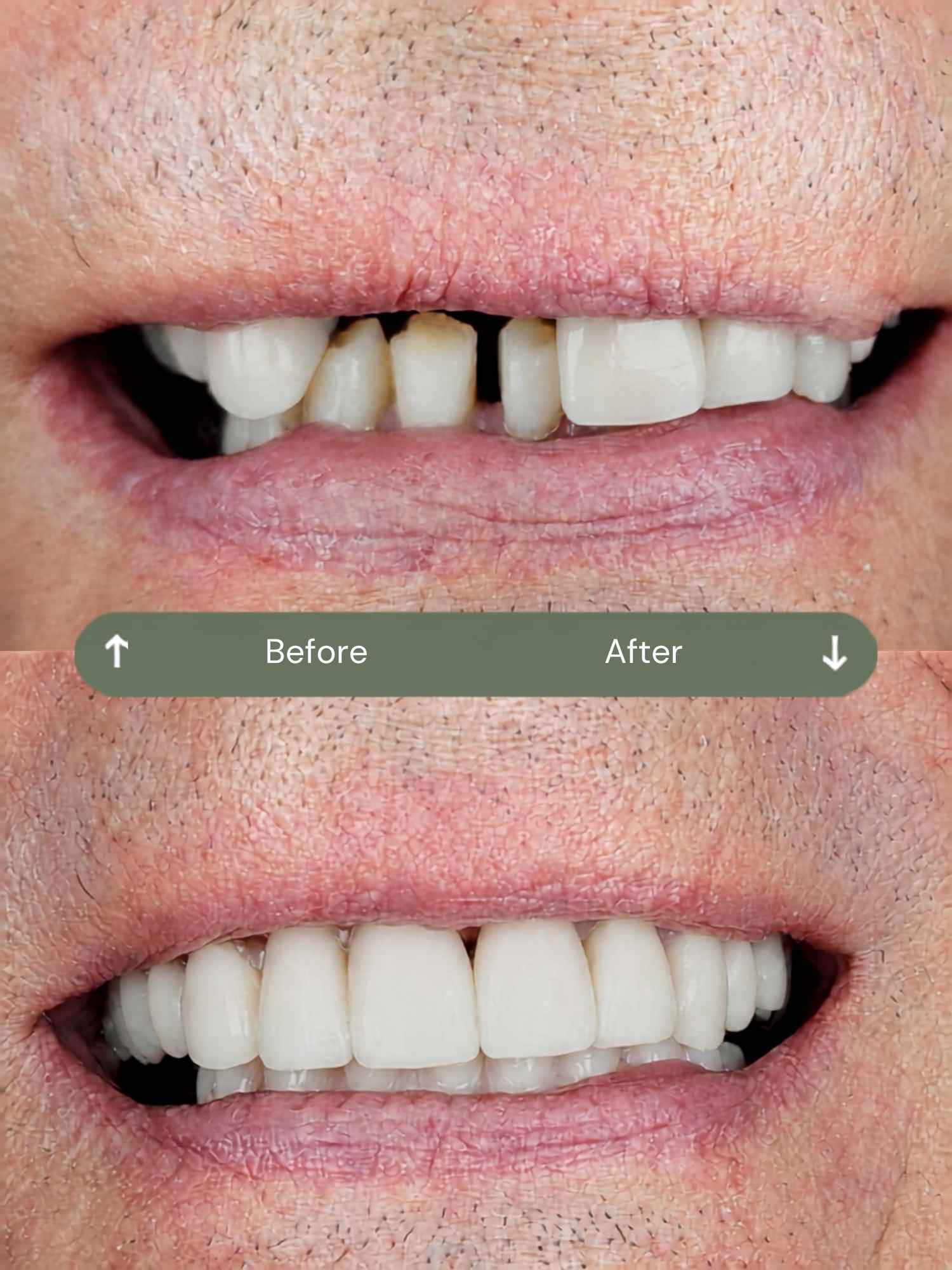 before and after dental implants