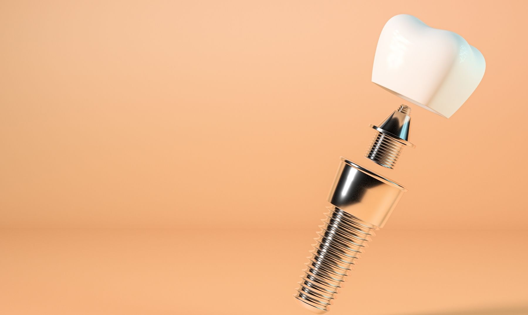 dental implant